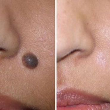 mole_removal